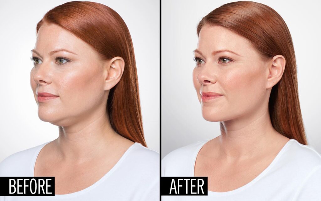 Chin enhancement