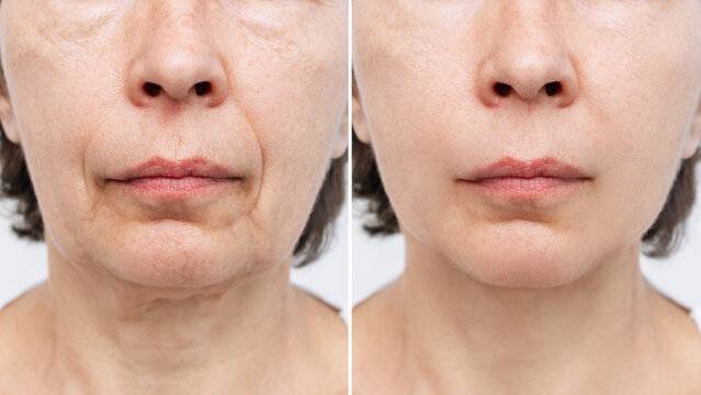 Wrinkle treatment result