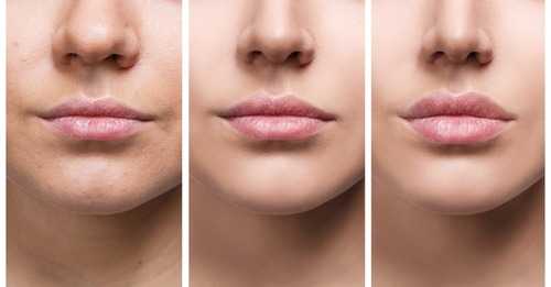 Lips Of Young Woman Before And After Augmentation