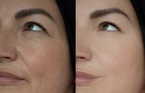 Woman Face Wrinkle Before And After Treatment