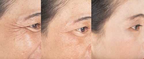 Wrinkles on the eyes. And before and after melasma.