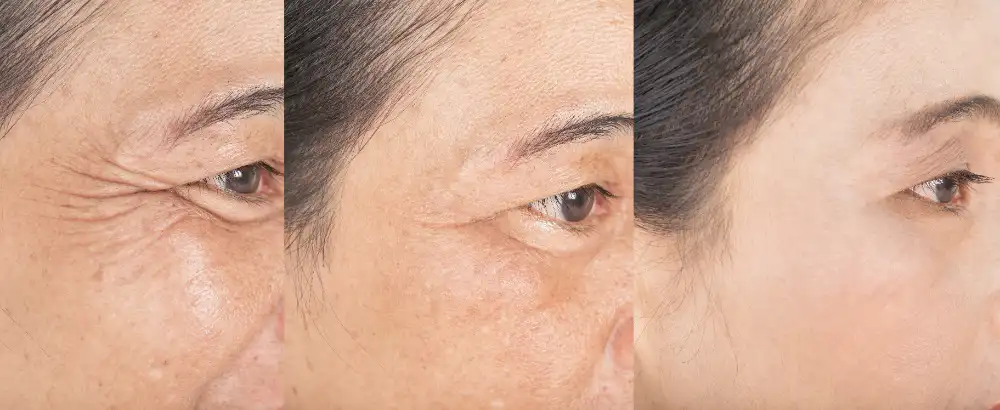 Dermal Filler Treatments near Plano